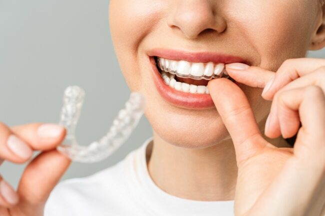 ortodoncia invisible en Burjassot - tipos