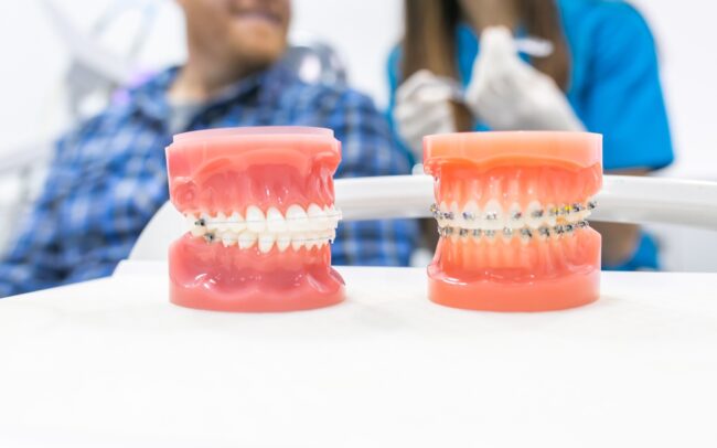 ortodoncia en Burjassot - modelos dentales