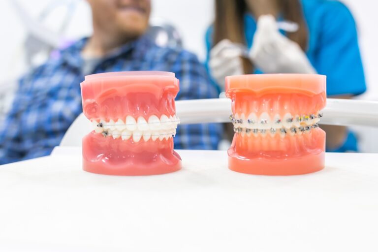 ortodoncia en Burjassot - modelos dentales