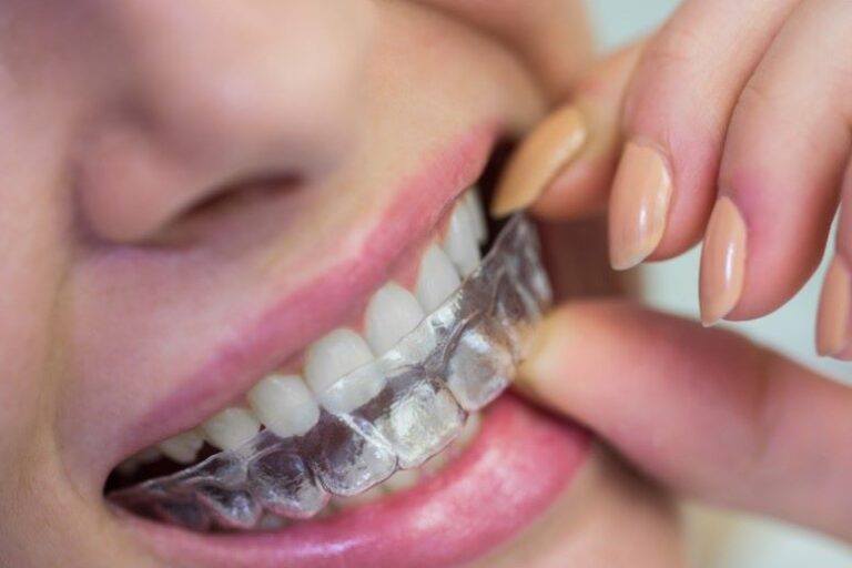 Ortodoncia en Burjassot - Dientes