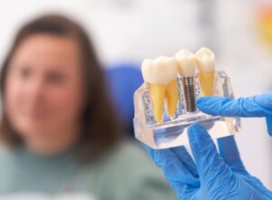 Implantes fijos en el mismo dia en Valencia - Piezas