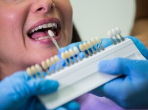 Implantes fijos en el mismo dia en Valencia - Prótesis