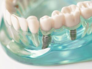 Implantes con dientes fijos en el mismo día en Valencia - Prótesis