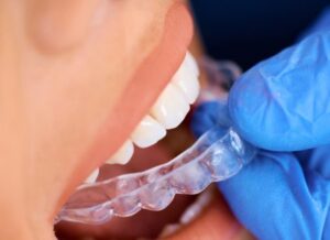 Ortodoncia invisalign en Burjassot - Azul