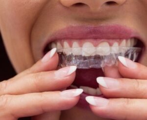 Ortodoncia invisalign en burjassot - Dientes