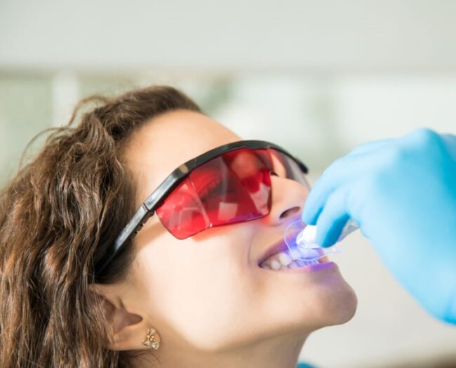 Blanqueamiento dental en Burjassot - Lentes