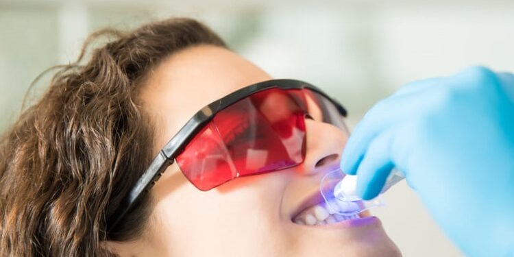 Blanqueamiento dental en Burjassot - Lentes
