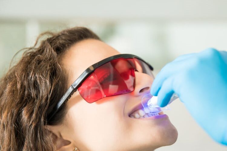 Blanqueamiento dental en Burjassot - Lentes