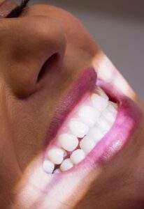 Blanqueamiento dental en Burjassot - Sonreír