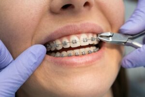 Dentista en Burjassot - Brackets
